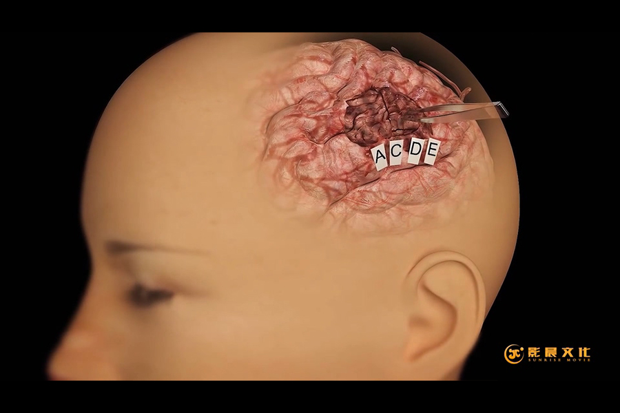 黃埔醫(yī)療行業(yè)三維動(dòng)畫制作-醫(yī)療技術(shù)展