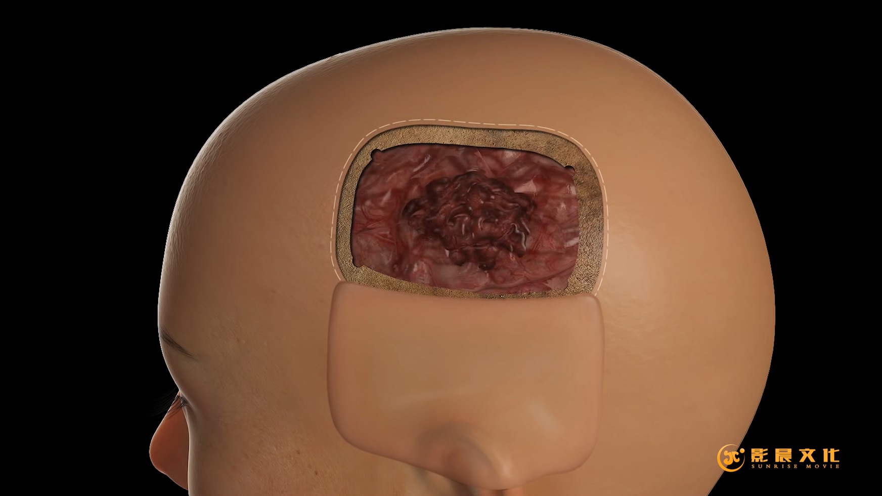 廣州病毒感染三維動(dòng)畫(huà)